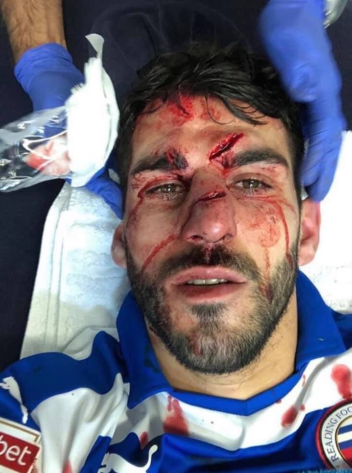 L'ex Rennais Nelson Oliveira défiguré après s'être fait marcher dessus par Tyrone Mings L'ex Rennais Nelson Oliveira défiguré après s'être fait marcher dessus par Tyrone Mings